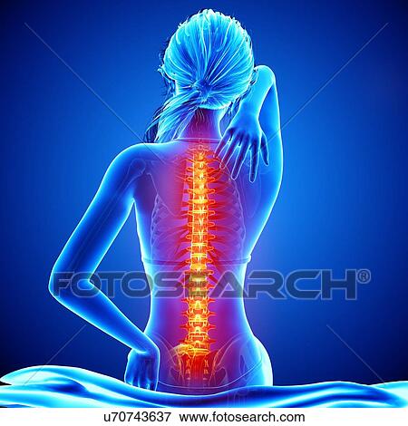 Back pain, artwork View Large Illustration Stock Illustration - Back pain, artwork. Fotosearch