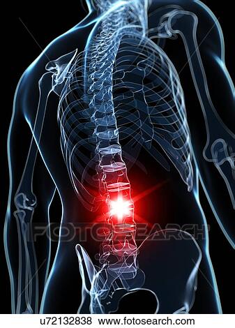 Back pain, artwork View Large Illustration Stock Illustration - Back pain, artwork. Fotosearch