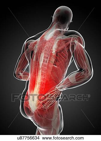 Stock Illustration - Back pain, artwork. Fotosearch