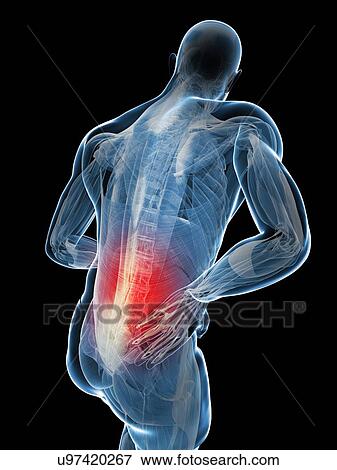 Back pain, artwork View Large Illustration Stock Illustration - Back pain, artwork. Fotosearch