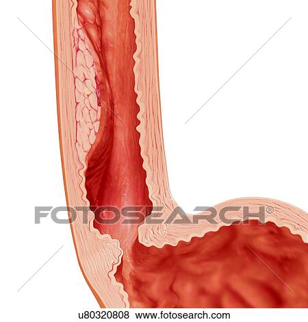 Stock Illustration - Barrett oesophagus symptoms, artwork. Fotosearch
