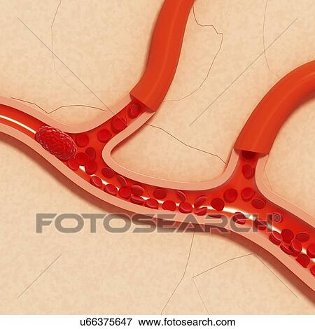 Stock Illustration - Brain stoke, artwork. Fotosearch