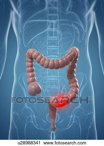 Colon cancer, artwork View Large Illustration Clip Art - Colon cancer, artwork. Fotosearch