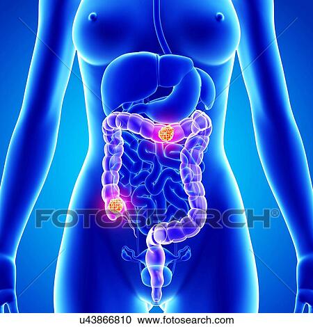 Colon cancer, artwork View Large Illustration Clipart - Colon cancer, artwork. Fotosearch