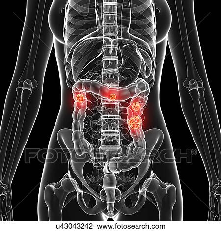 Drawing - Colon cancer, artwork. Fotosearch