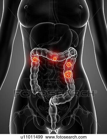 Colon cancer, artwork View Large Illustration Stock Illustration - Colon cancer, artwork. Fotosearch