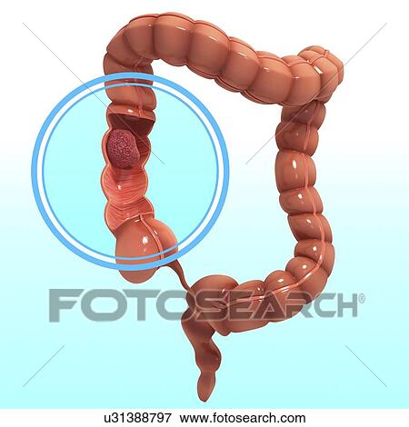 Stock Illustration - Colon cancer, artwork. Fotosearch