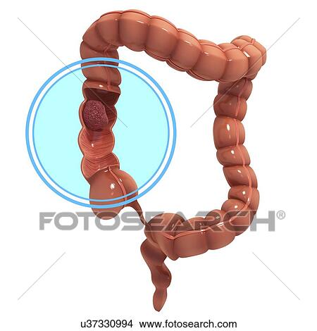 Colon cancer, artwork View Large Illustration Stock Illustration - Colon cancer, artwork. Fotosearch