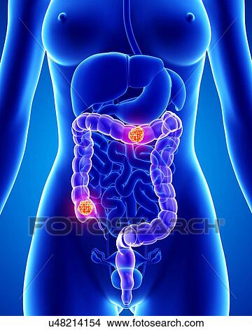 Colon cancer, artwork View Large Illustration Stock Illustration - Colon cancer, artwork. Fotosearch