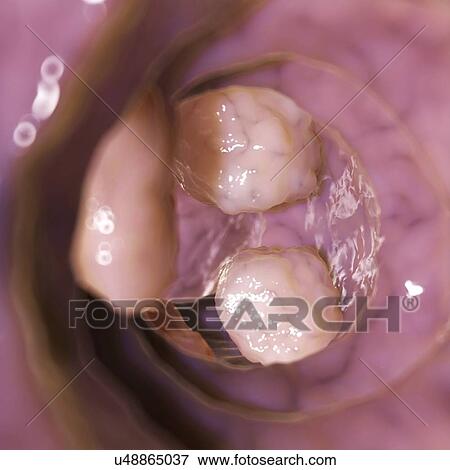 Stock Illustration - Colon cancer, artwork. Fotosearch
