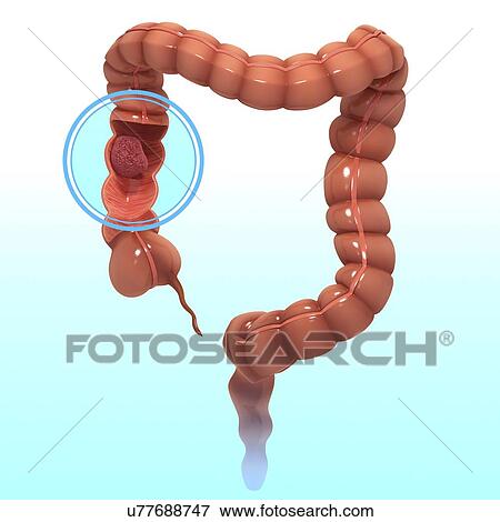 Stock Illustration - Colon cancer, artwork. Fotosearch