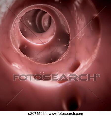 Colon diverticuli, artwork View Large Illustration Stock Illustration - Colon diverticuli, artwork. Fotosearch