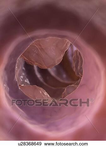 Colon tumor, artwork View Large Illustration Stock Illustration - Colon tumor, artwork. Fotosearch