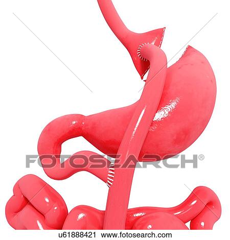 Gastric bypass, artwork View Large Illustration Clip Art - Gastric bypass, artwork. Fotosearch