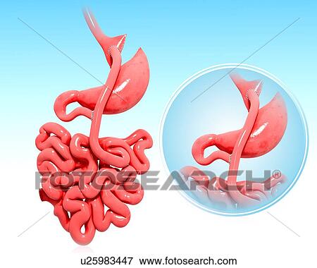 Stock Illustration - Gastric bypass, artwork. Fotosearch