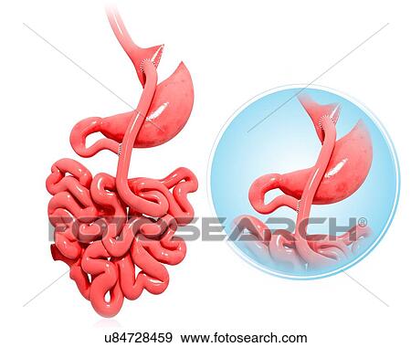Stock Illustration - Gastric bypass, artwork. Fotosearch
