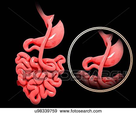 Stock Illustration - Gastric bypass, artwork. Fotosearch