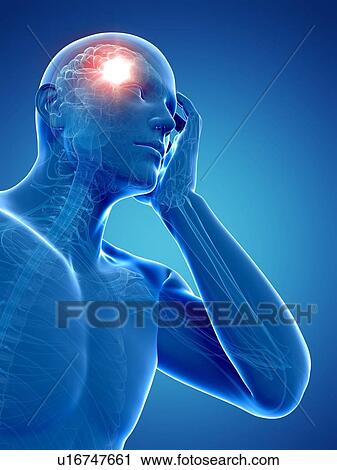 Clip Art - Headache, artwork. Fotosearch