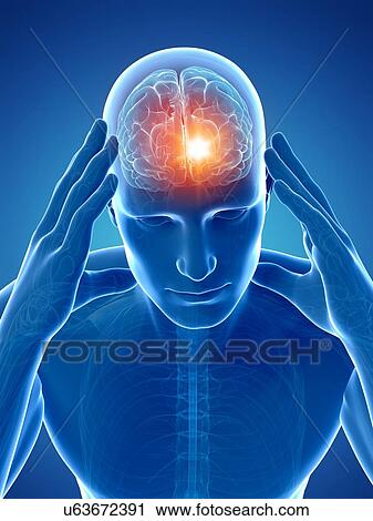 Headache, artwork View Large Illustration Clip Art - Headache, artwork. Fotosearch