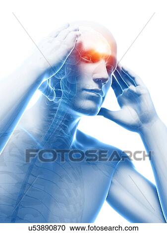 Clipart - Headache, artwork. Fotosearch