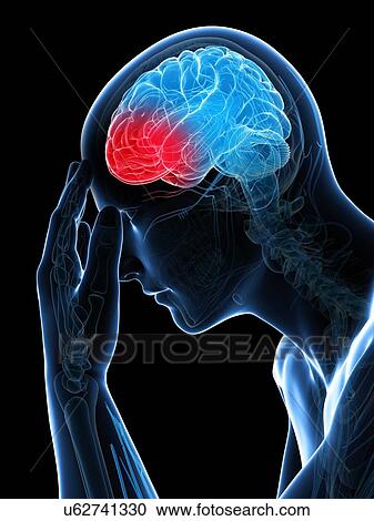 Clipart - Headache, artwork. Fotosearch