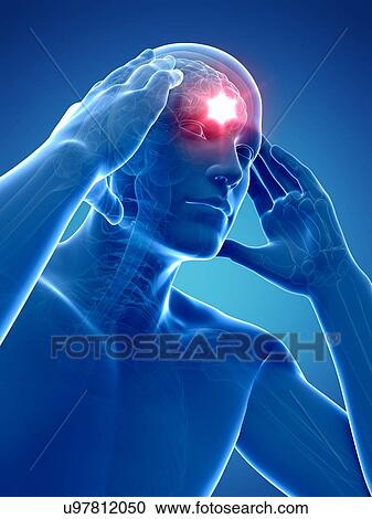 Headache, artwork View Large Illustration Clipart - Headache, artwork. Fotosearch