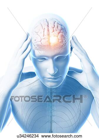 Stock Illustration - Headache, artwork. Fotosearch