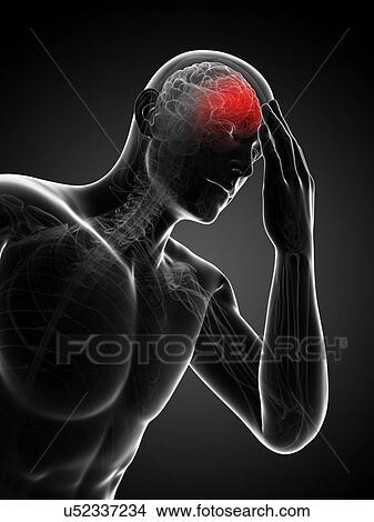 Stock Illustration - Headache, artwork. Fotosearch