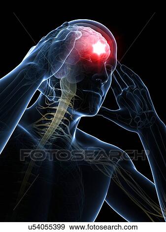 Headache, artwork View Large Illustration Stock Illustration - Headache, artwork. Fotosearch