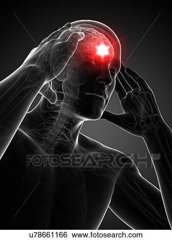 Stock Illustration - Headache, artwork. Fotosearch