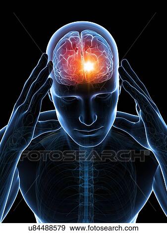 Stock Illustration - Headache, artwork. Fotosearch