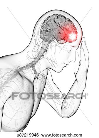 Stock Illustration - Headache, artwork. Fotosearch