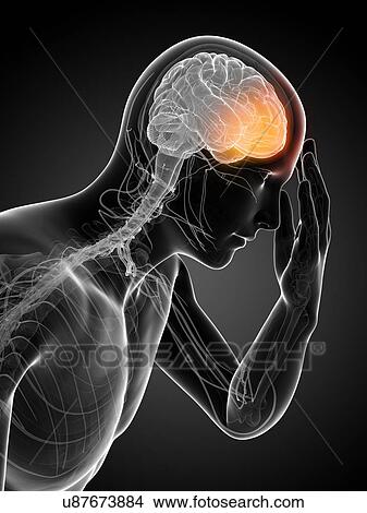 Headache, artwork View Large Illustration Stock Illustration - Headache, artwork. Fotosearch