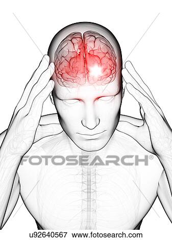 Stock Illustration - Headache, artwork. Fotosearch
