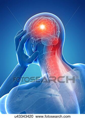 Clipart - Headache due to muscle pain, artwork. Fotosearch