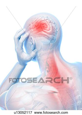 Stock Illustration - Headache due to muscle pain, artwork. Fotosearch