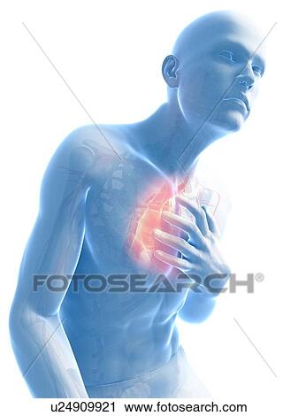 Heart attack, artwork View Large Illustration Clip Art - Heart attack, artwork. Fotosearch