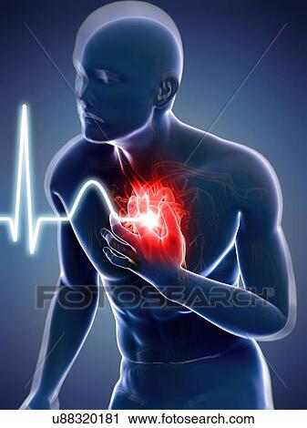 Heart attack, artwork View Large Illustration Clip Art - Heart attack, artwork. Fotosearch