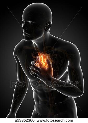 Heart attack, artwork View Large Illustration Clipart - Heart attack, artwork. Fotosearch
