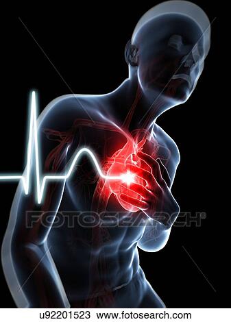 Drawing - Heart attack, artwork. Fotosearch