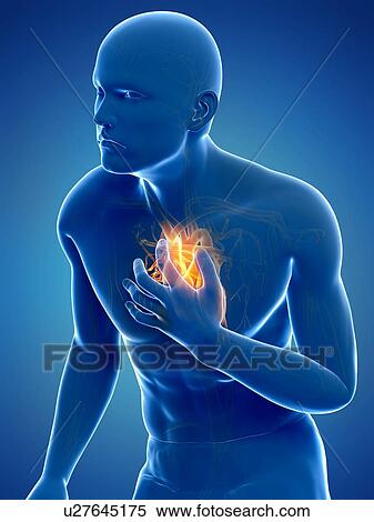Heart attack, artwork View Large Illustration Stock Illustration - Heart attack, artwork. Fotosearch
