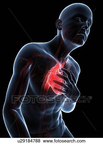 Heart attack, artwork View Large Illustration Stock Illustration - Heart attack, artwork. Fotosearch