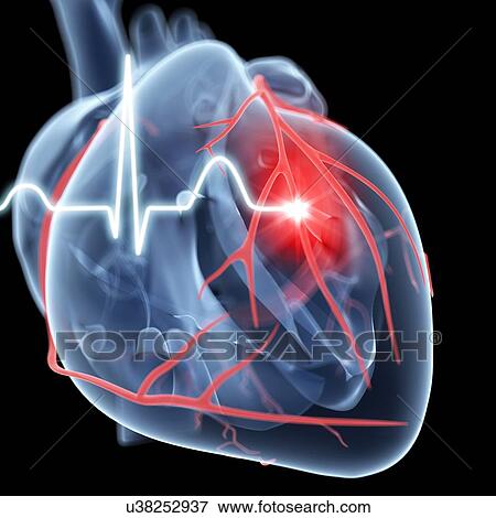 Heart attack, artwork View Large Illustration Stock Illustration - Heart attack, artwork. Fotosearch