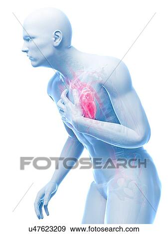Heart attack, artwork View Large Illustration Stock Illustration - Heart attack, artwork. Fotosearch