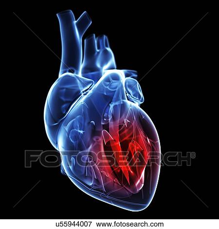 Stock Illustration - Heart attack, artwork. Fotosearch