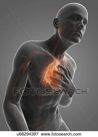 Heart attack, artwork View Large Illustration Stock Illustration - Heart attack, artwork. Fotosearch