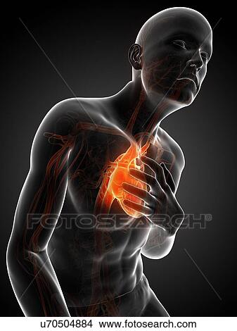 Stock Illustration - Heart attack, artwork. Fotosearch