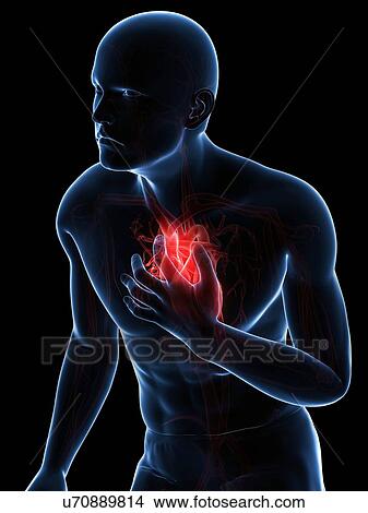 Stock Illustration - Heart attack, artwork. Fotosearch