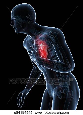 Stock Illustration - Heart attack, artwork. Fotosearch