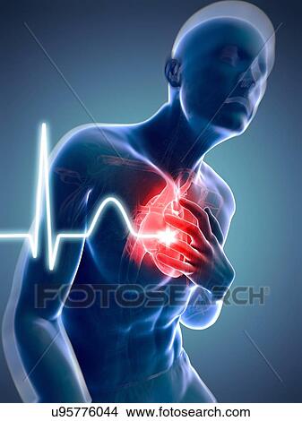 Heart attack, artwork Stock Illustration | u95776044 | Fotosearch